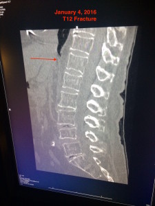 T12 Fracture