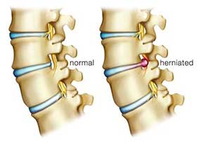 herniated disc