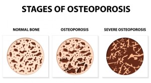 -of-osteoporosis